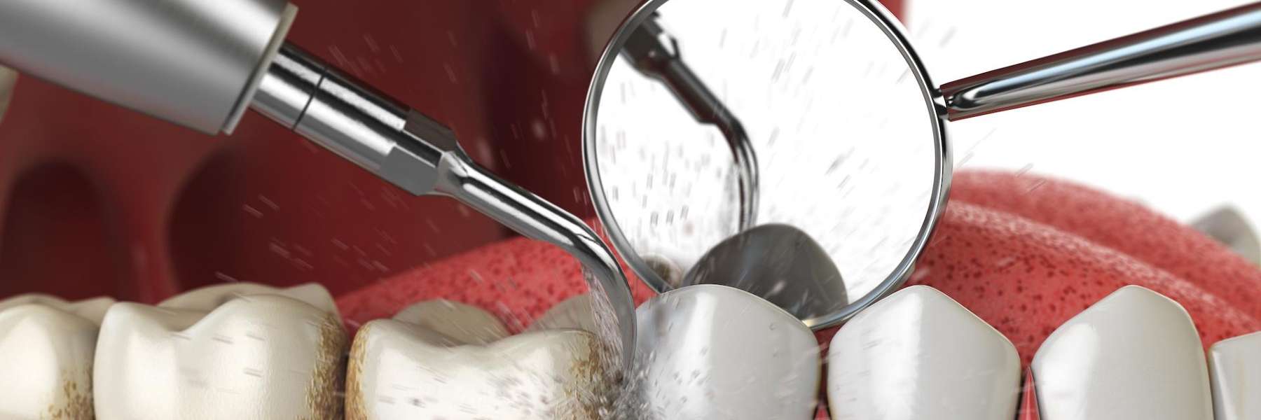 A dental technician treats advanced periodontal disease with specialized tools.