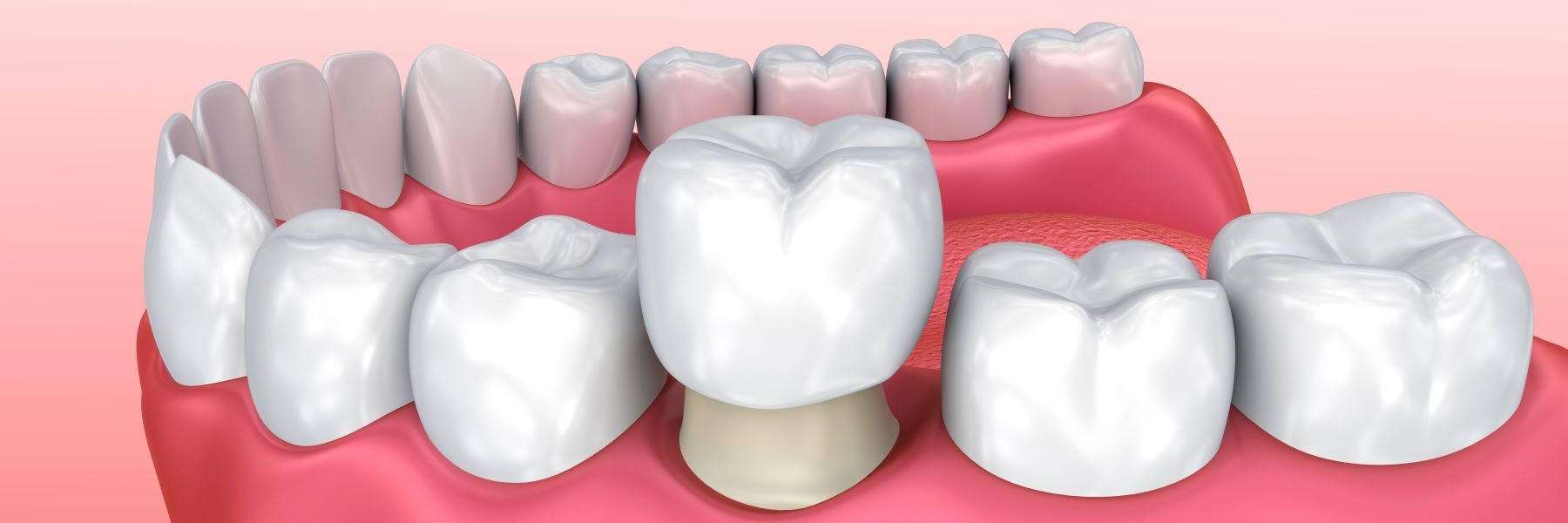 Close-up of a dental implant and crown, highlighting special care needs.