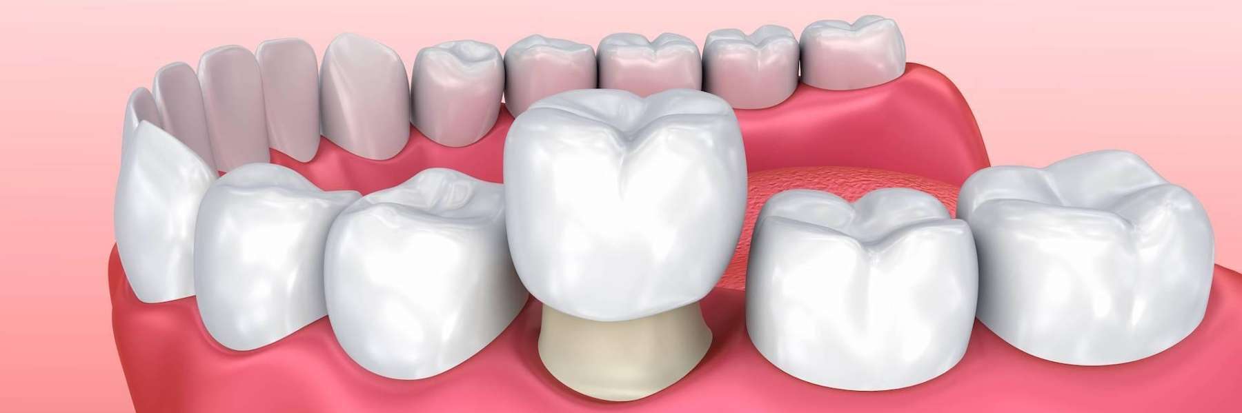 Illustration of a dental crown, helping Bellevue patients understand their options at Kennedy Dental