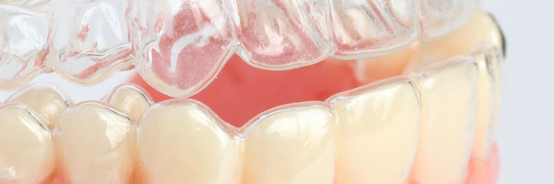 teeth with aligner