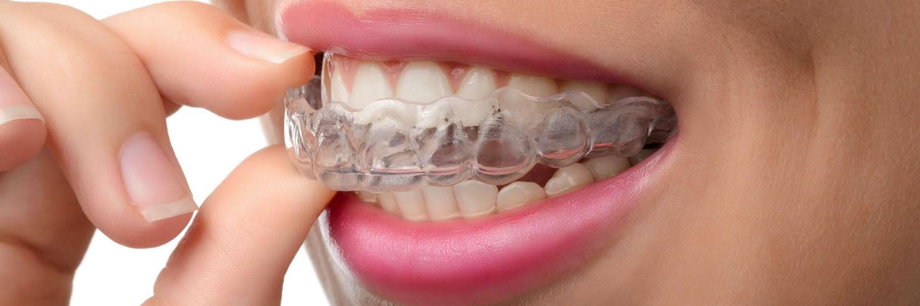 A woman confidently showcases her Invisalign braces, a modern alternative to metal braces.