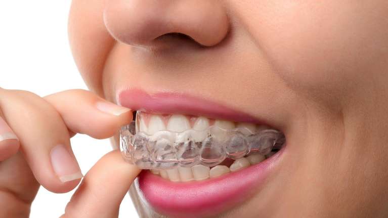 Do teeth Relapse After Invisalign?
