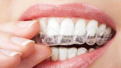 Lady wearing full Invisalign in Bellevue NE